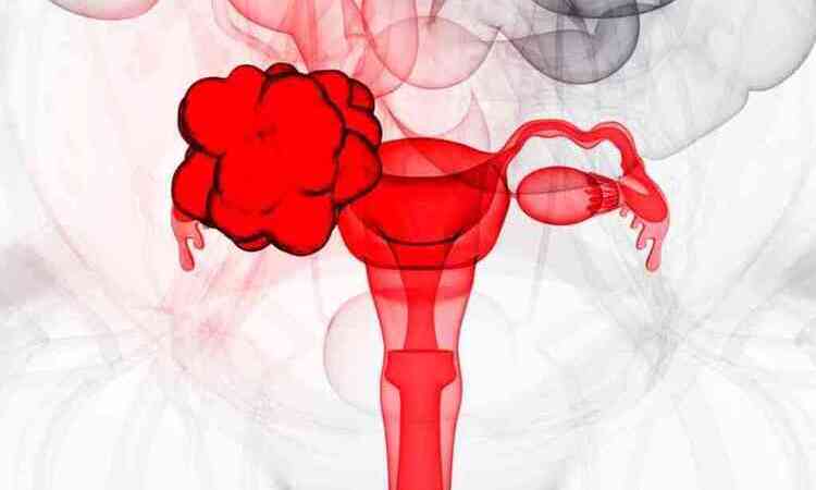 Penyakit kista ovarium, Sumber: daai.tv
